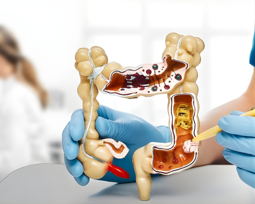 Model of the human colon with a practitioner pointing to internal areas, illustrating digestive health and colon hydrotherapy treatments